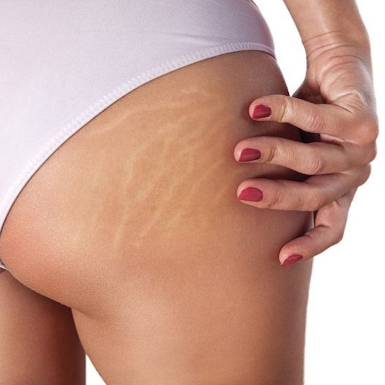 stretch marks