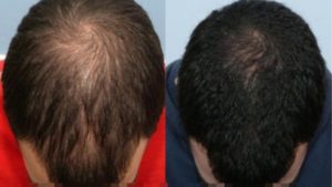 hair growth before after