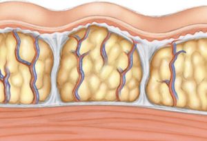 cellulite formation