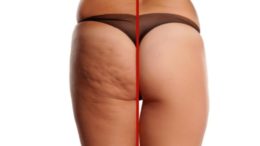 Cellulite