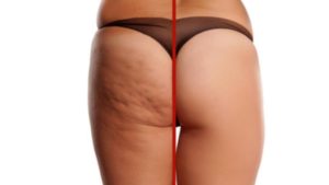 Cellulite