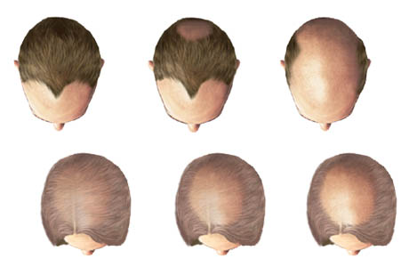 Androgenic Alopecia